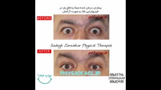 درمان قطعی فلج بلز توسط فیزیوتراپیست صادق زراعتکار