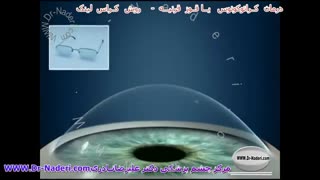 کراس لینکینگ یا CCL - مرکز چشم پزشکی دکتر علیرضا نادری