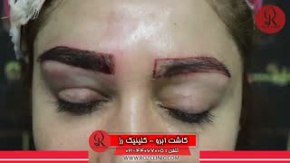 کاشت ابرو | فیلم کاشت ابرو | کلینیک پوست و مو رز | شماره106