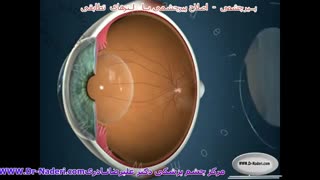لنزهای داخل چشمی تطابقی - مرکز چشم پزشکی دکتر علیرضا نادری
