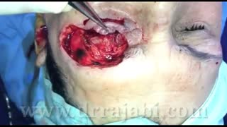 بازسازی همزمان ابرو ، پلک بالا و پلک تحتانی