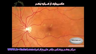 عکسبرداری از شبکیه - مرکز چشم پزشکی دکتر علیرضا نادری