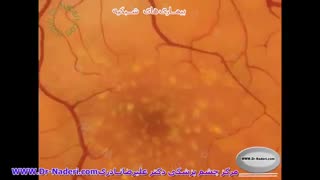 بیماری های شبکیه - مرکزچشم پزشکی دکتر علیرضا نادری