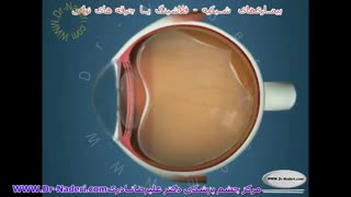 فلاشینگ یا جرقه های نورانی(PVD)- مرکز چشم دکتر علیرضا نادری