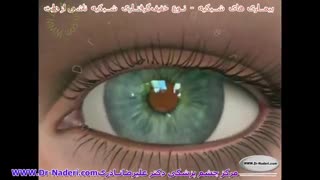 نوع خفیف اثر دیابت بر شبکیه - مرکزچشم پزشکی دکترعلیرضا نادری