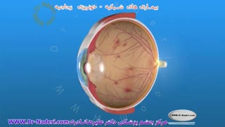 خونریزی زجاجیه-مرکز چشم پزشکی دکتر علیرضا نادری