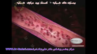 انسداد ورید شبکیه CRVO- مرکزچشم پزشکی دکتر علیرضا نادری