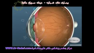 درمان سوراخ ماکولا  - مرکزچشم پزشکی دکتر علیرضا نادری