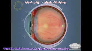پارگی شبکیه Tear - مرکزچشم پزشکی دکتر علیرضا نادری