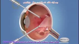 ویترکتومی چیست؟ -مرکزچشم پزشکی دکتر علیرضا نادری ترمیم سوختگی
