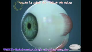 خال مشیمیه (کوروئید)- مرکزچشم پزشکی دکتر علیرضا نادری