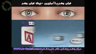 درمان تنبلی چشم - مرکز چشم پزشکی دکتر علیرضا نادری