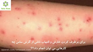 درمان خانگی ساس گزیدگی