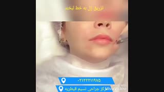 تزریق ژل جراحی بینی