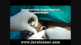 اسفنکتروتومی بسته شقاق - کلینیک مهنا