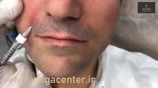 تزریق ژل