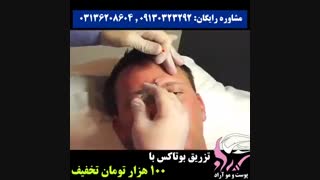 تزریق بوتاکس خطوط اخم و پیشانی