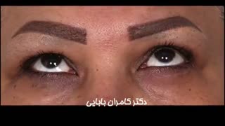 بلفاروپلاستی