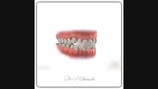 درمان ارتودنسی | دکتر قریشی هایفوتراپی