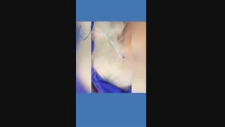 جراحی پاروتید