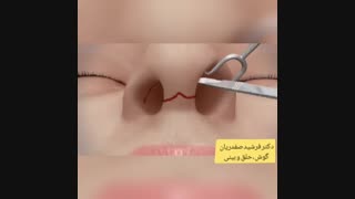 خلاصه جراحی زیبایی بینی به صورت شماتیک