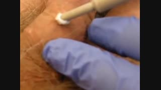 کرایو تراپی زگیل تناسلی / درمان به روش فریز