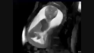 لگد زدن جنین