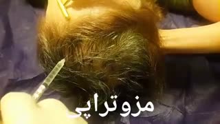مزوتراپی - 22807060