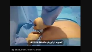لاغری موضعی سریع با لیپوماتیک