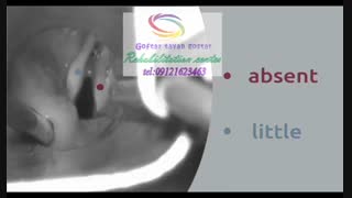 مراکز درمانی حنجره و صوت،انواع بیماری های حنجره و اختلالات صوت|گفتار توان گستر البرز09121623463