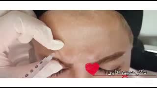 فیلم تزریق بوتاکس به پیشانی مزوتراپی