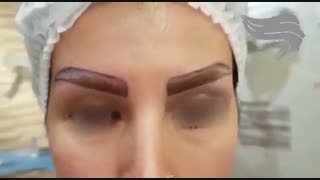 کاشت ابرو بابی حسی