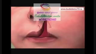 شکاف کام و شکاف لب نوزاد چیست و چگونه درمان می‌شود|گفتار توان گستر09121623463
