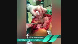 فیلم جراحی رباط صلیبی و منیسک