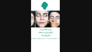 بینى گوشتى با دفورمیتى و ضعف غضروف ها | دکتر رستمی