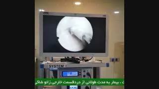 کیست منیسک لترال زانو