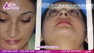 عمل زیبایی بینی