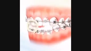 فیلم ارتودنسی متحرک