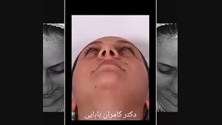 نمونه کار جراحی بینی دکتر کامران بابایی لیفت صورت