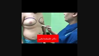فیلم کوچک کردن سینه در مردان