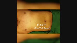 لیپوماتیک - دکتر ابدالی - 22807060