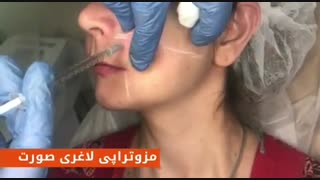 فیلم مزوتراپی - لاغری صورت
