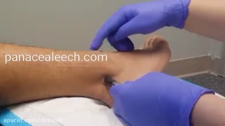 تاثیر شگفت انگیز زالو درمانی در جراحی و پیوند اعضاء- کلینیک زالو درمانی پاسداران
