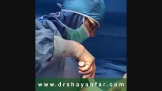 فیلم خارج کردن فیبروم رحمی با حفظ رحم