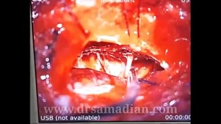 عمل جراحی تومور مننژیوم CPA بزرگ با حفظ عصب شنوایی