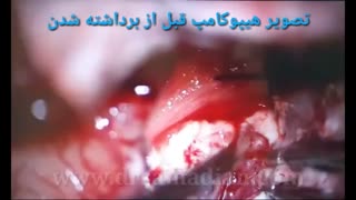 جراحی صرع مقاوم به درمان پیلینگ شیمیایی