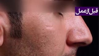 نمونه جراحی زیبایی بینی دکتر گیلدا گیوه چی