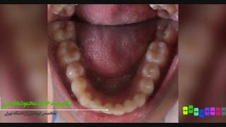 فیلم قبل و بعد از درمان ارتودنسی