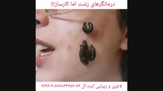 رفع جای جوش و جوش با زالودرمانی