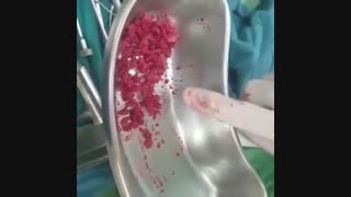 فیلم عمل سیاه شدن سراستخوان ران